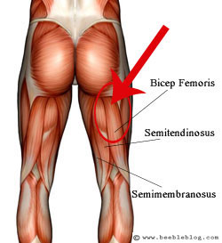 Hamstring injury - biceps femoris